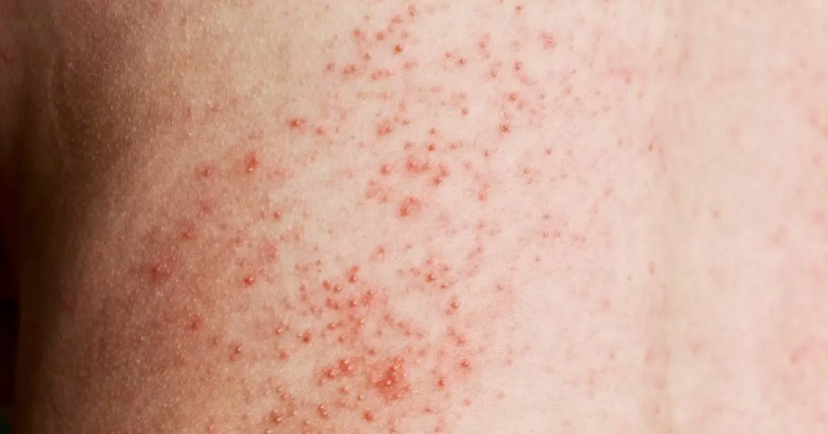 mold health problems